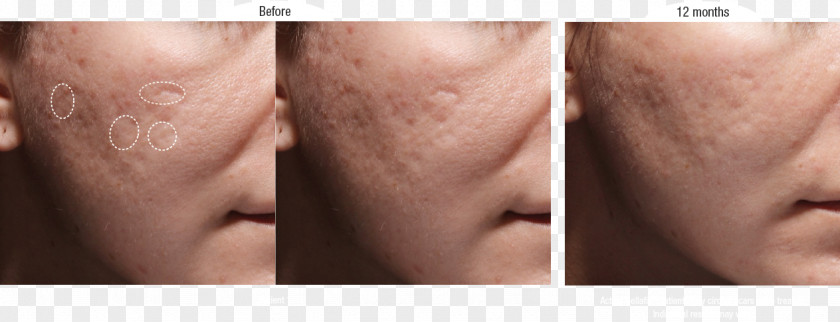 Acne Scars Scar Injectable Filler Wrinkle Dermatology PNG