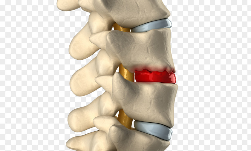 Back Pain Spinal Disc Herniation Degenerative Disease Intervertebral Vertebral Column Osteophyte PNG