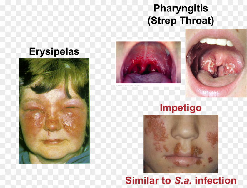 Nose Lip Cheek Streptococcal Pharyngitis Chin Tonsillitis PNG