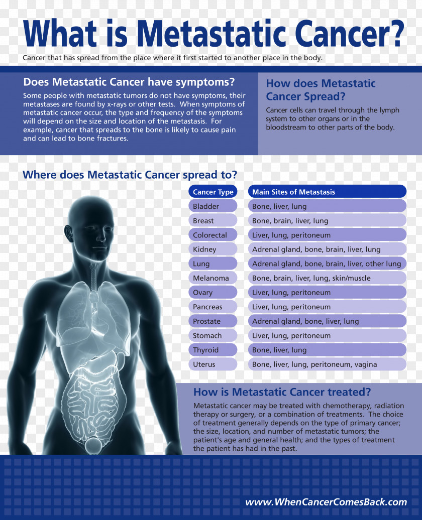 Brain Reno CyberKnife Metastasis Cancer Radiosurgery PNG