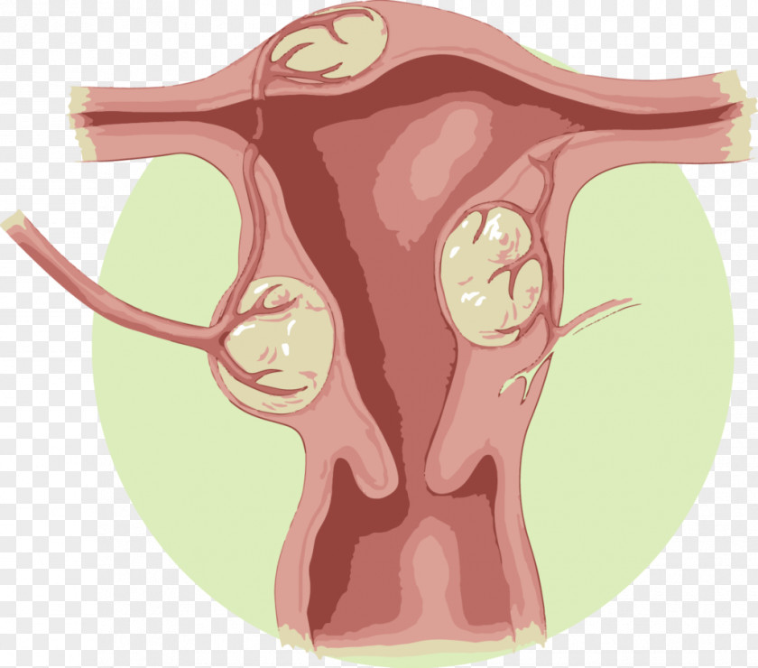 Uterine Fibroid Artery Embolization Uterus Benign Tumor PNG