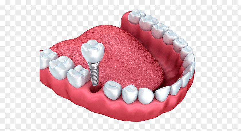Dental Implant Dentistry Tooth PNG