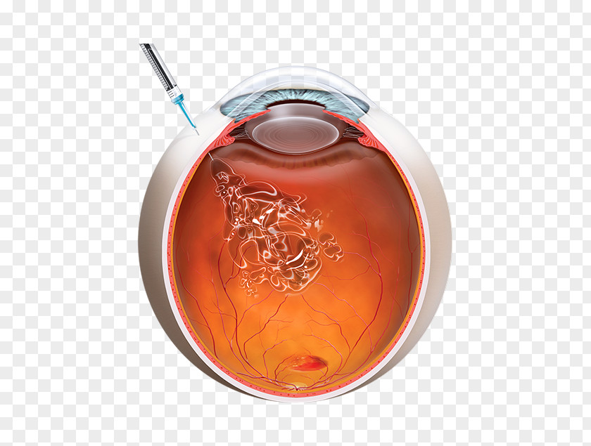 Eye Intravitreal Administration Macular Degeneration Injection Bevacizumab Anti–vascular Endothelial Growth Factor Therapy PNG