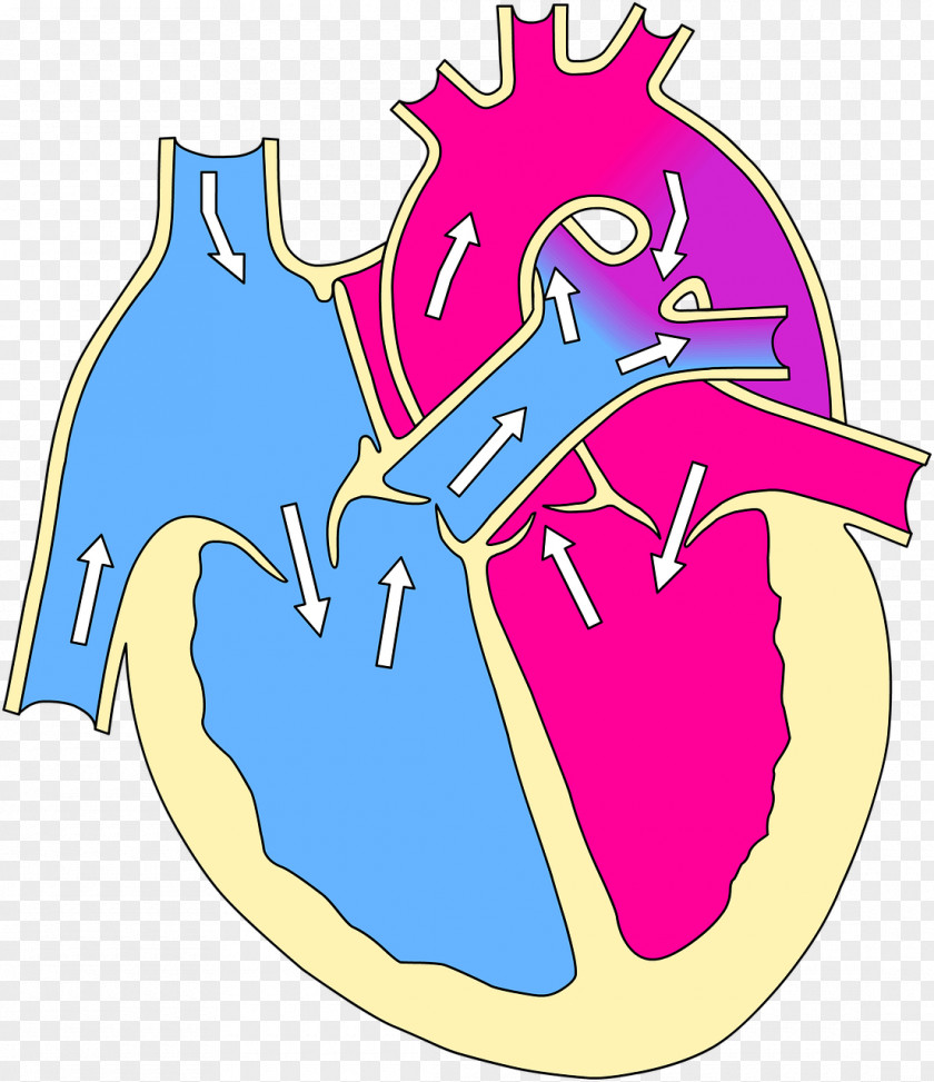 Heart Attack Tetralogy Of Fallot Ventricular Septal Defect Congenital Patent Ductus Arteriosus PNG