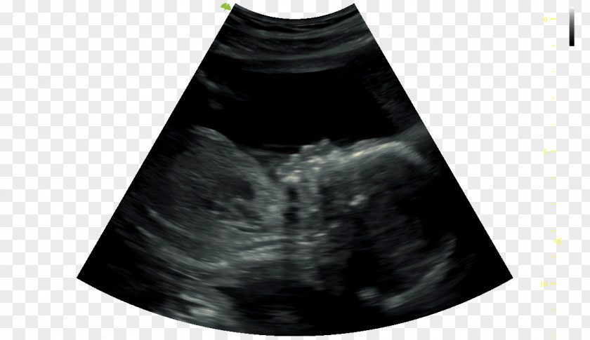 Day To End Obstetric Fistula Ultrasound Technology 4D Film Infant Black M PNG