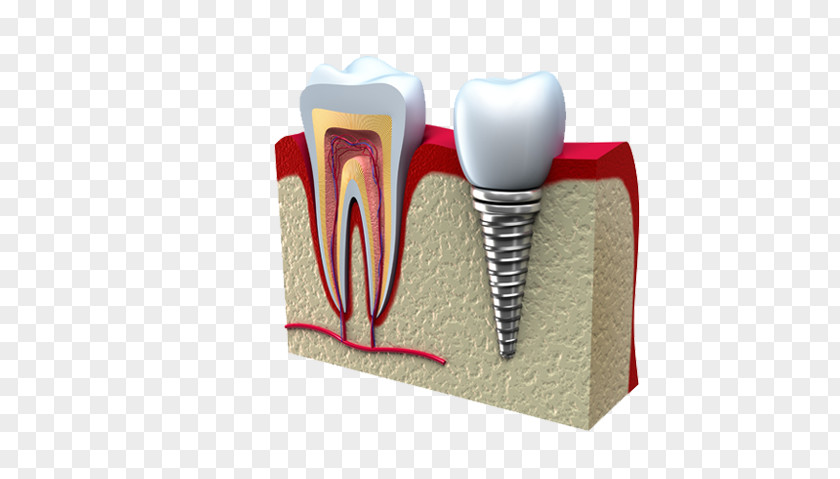Crown Dental Implant Dentistry Molar PNG