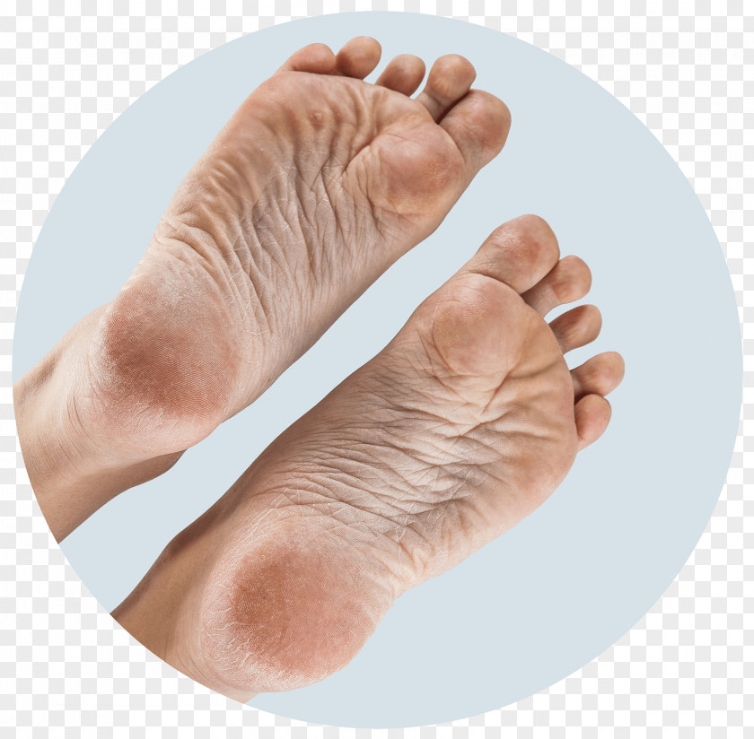 Hand Foot Sole Callus Joint PNG