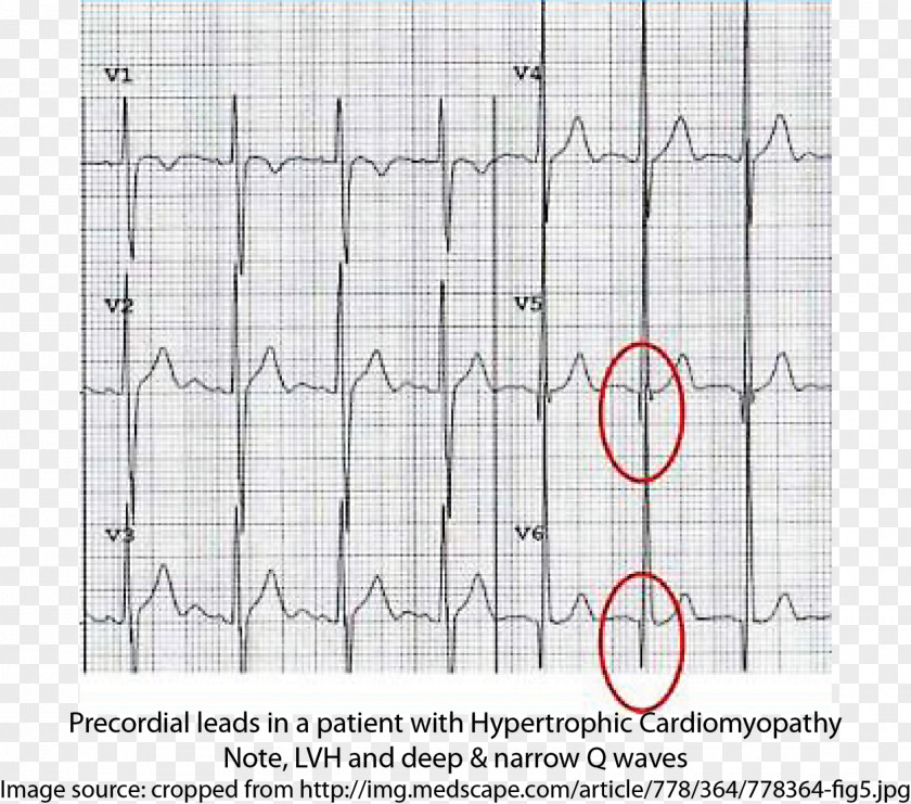 Hypertrophic Cardiomyopathy Electrocardiography Syncope Cardiac Arrest PNG