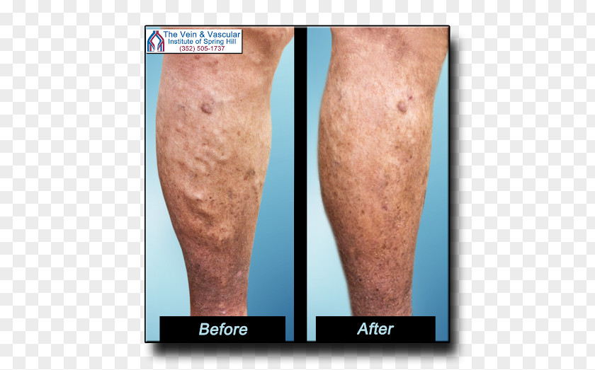 Varicose Veins Telangiectasia Endovenous Laser Treatment Sclerotherapy PNG