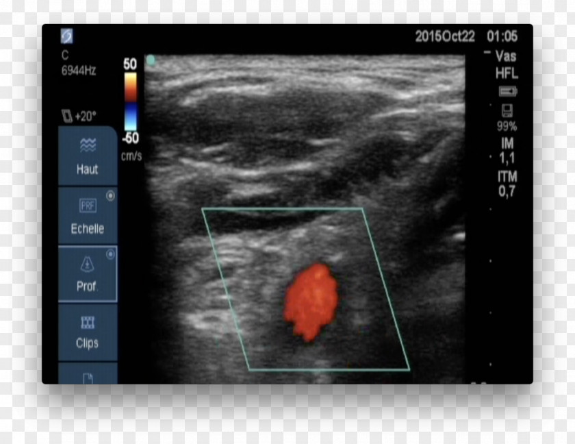 Blood Circulation Medical Imaging Magnetic Resonance Screenshot Medicine PNG
