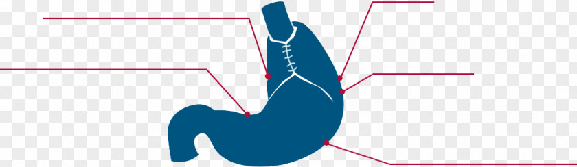 Gastroesophageal Reflux Disease Marina Del Rey Hospital Thumb Esophagitis Gastroenterology PNG