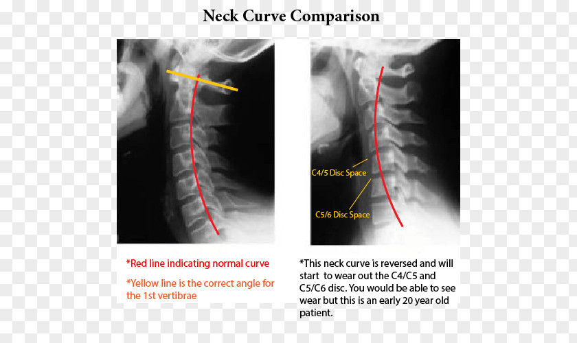 Normal Curve Neck Pain Whiplash Cervical Vertebrae X-ray PNG
