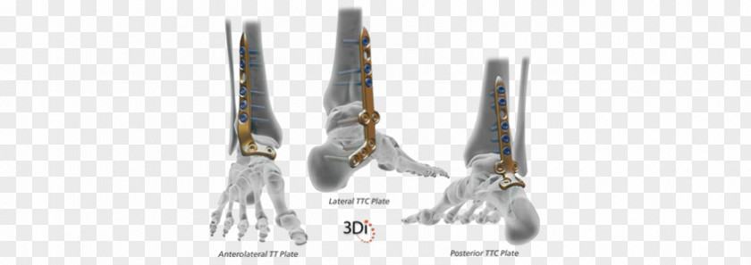 Medical Blades Wright Group Dynamic Compression Plate Ankle Medicine Surgery PNG