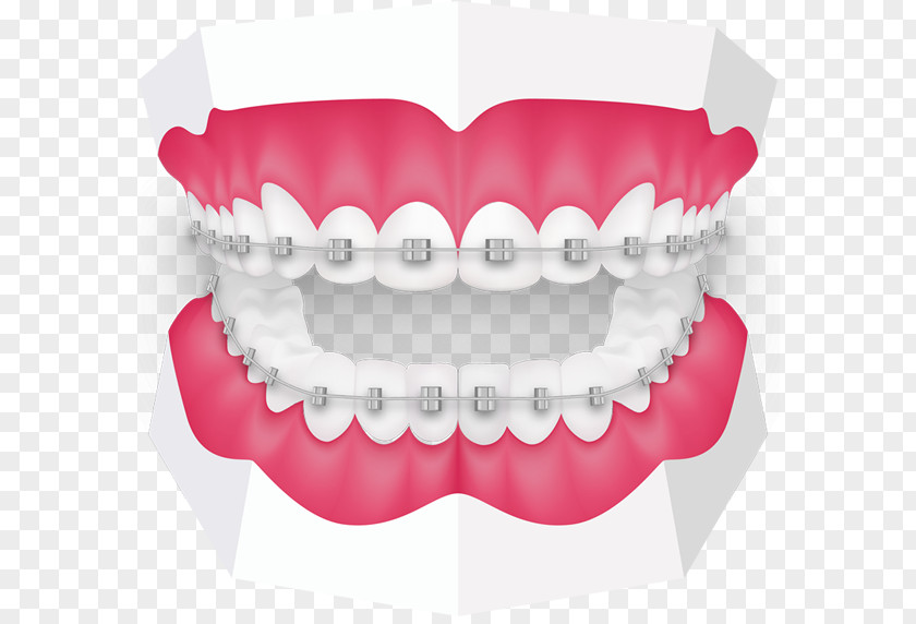 Tooth Orthodontics Dentistry Dental Braces Oral Hygiene PNG braces hygiene, Orthodontist clipart PNG