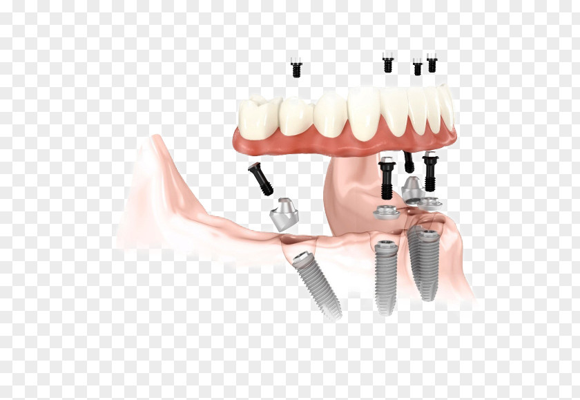 Crown Dental Implant Abutment Dentistry Dentures PNG