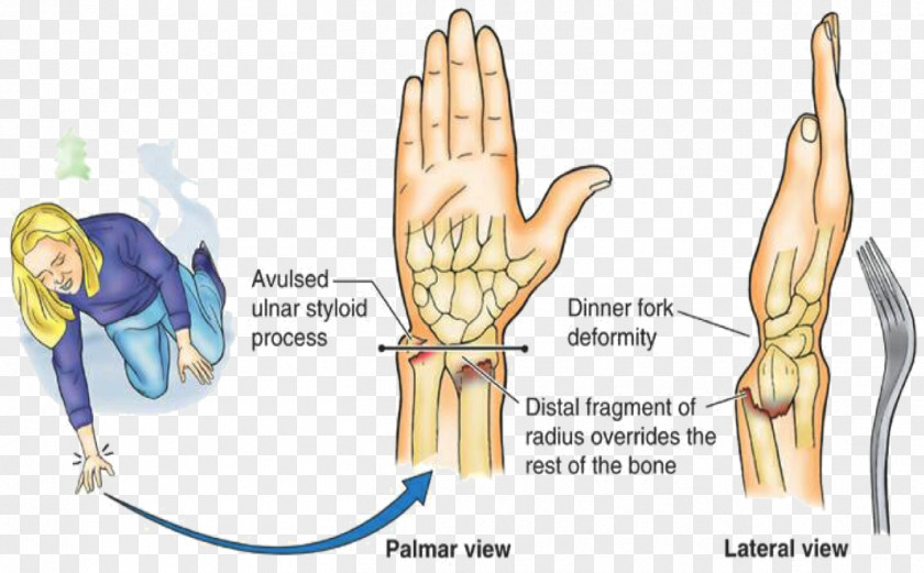 Colles' Fracture Distal Radius Smith's Physical Therapy Bone PNG