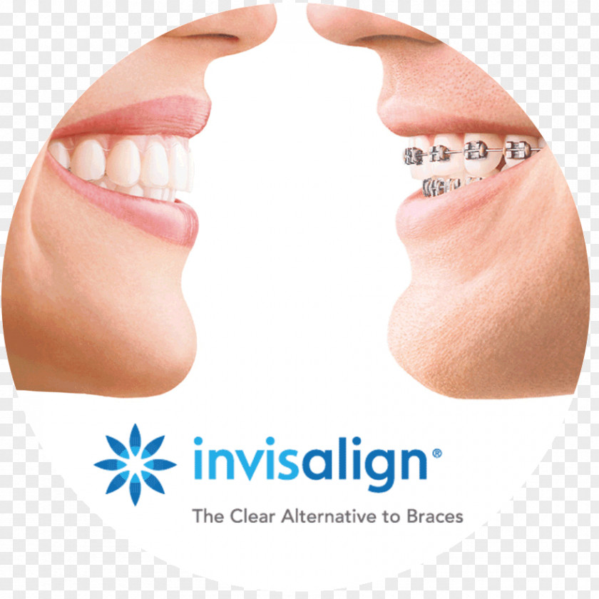 Invisalign Clear Aligners Dental Braces Orthodontics Dentistry Retainer PNG