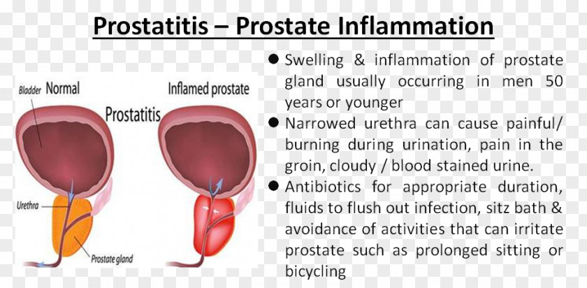 Prostate Gland Acute Prostatitis Benign Prostatic Hyperplasia Urinary Tract Infection PNG