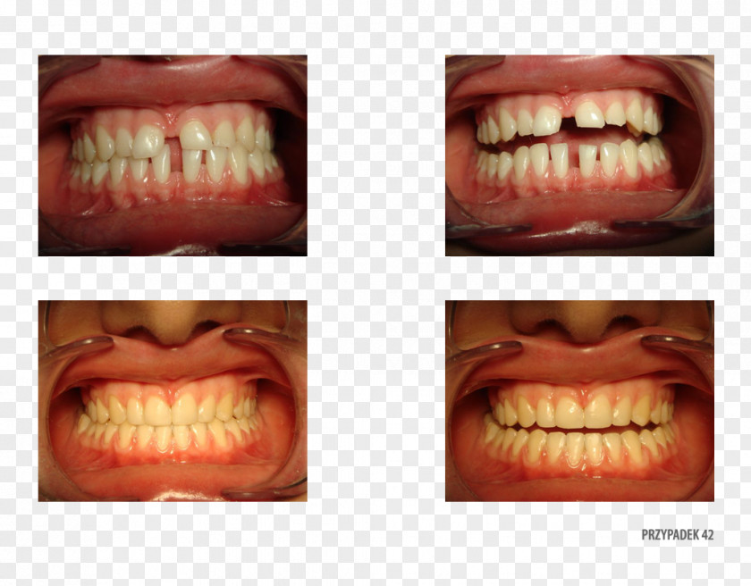 Tooth Close-up Therapy Patient .pl PNG