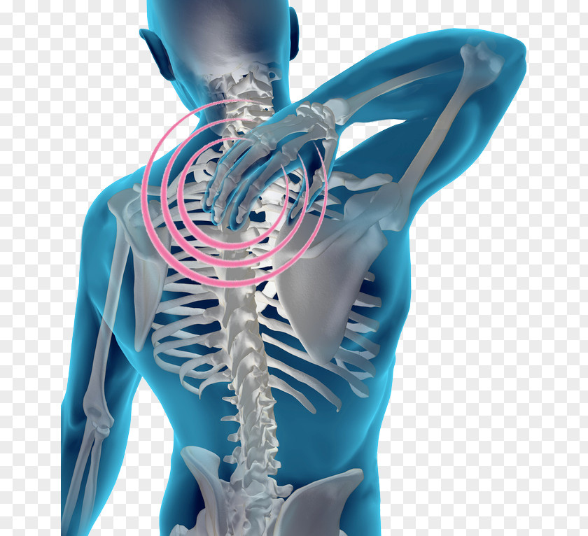 Chir Pain In Spine Vertebral Column Human Back Cervical Vertebrae Facet Joint PNG