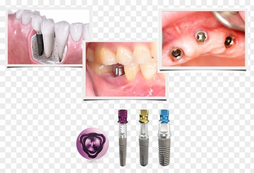 Implants Jaw Dentistry Dental Implant Tooth PNG