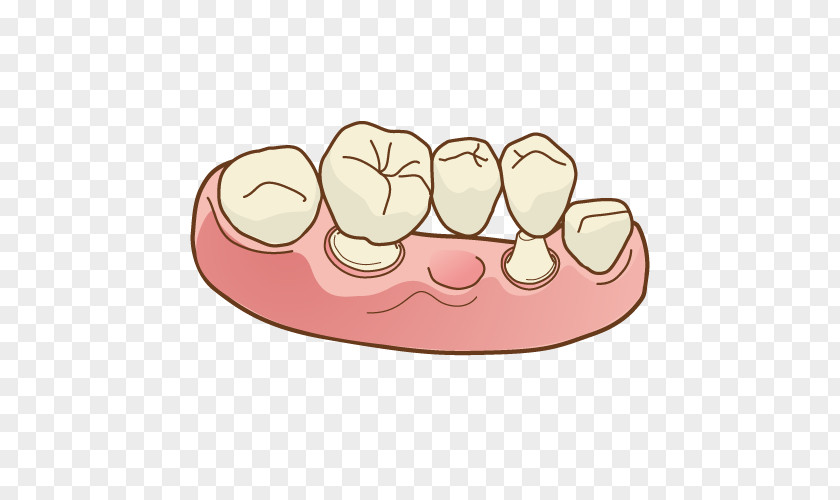 Bridge Dentist Dentures Therapy Dental Surgery 矯正歯科 PNG