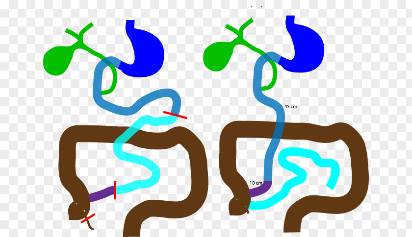 Gastric Bypass Surgery Roux-en-Y Anastomosis Jejunum Duodenal Switch PNG