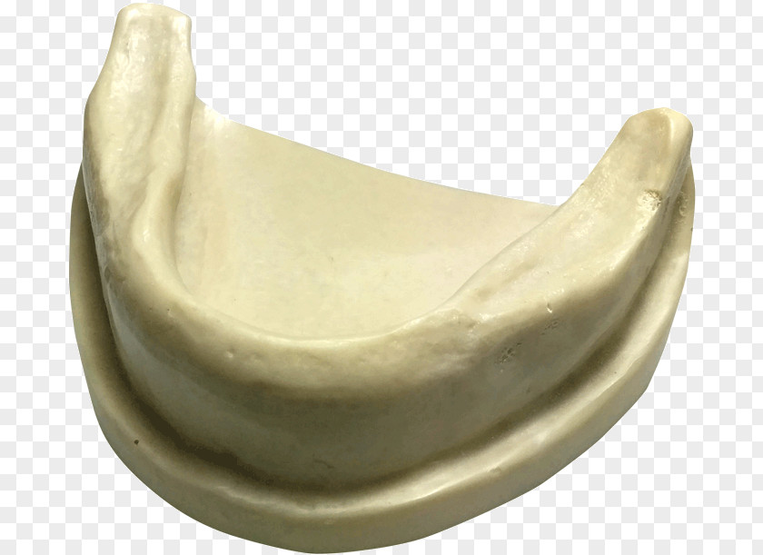 Dental Implants Mandible Anatomy Dentistry Maxilla Implantology PNG