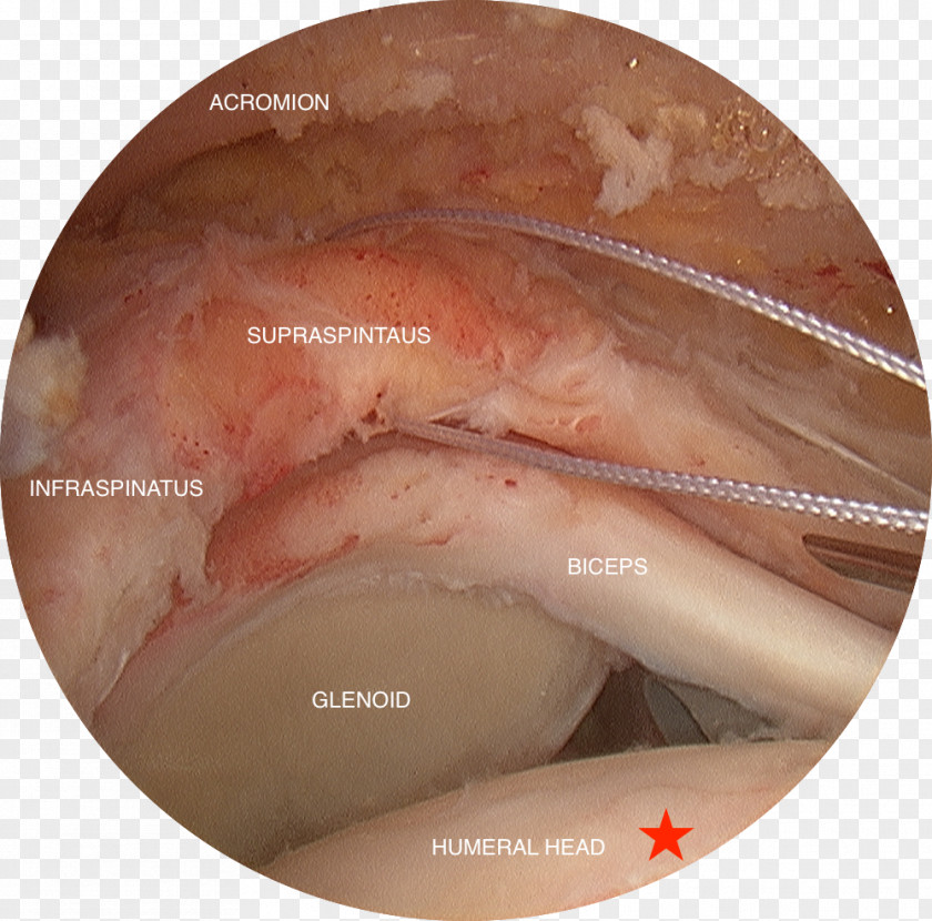 Infraspinatus Rotator Cuff Tear Supraspinatus Muscle Arthroscopy Surgery PNG