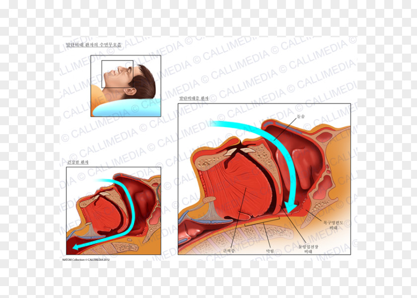 Sleep Disorder Acromegaly Face Nose Lip Arm PNG