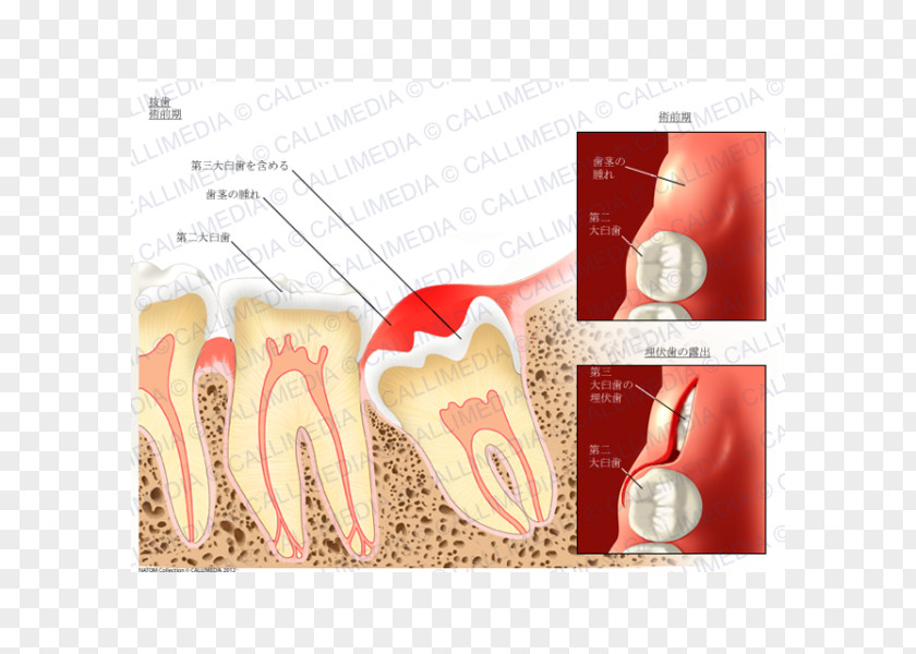 Dental Extraction Tooth Dentistry Molar PNG