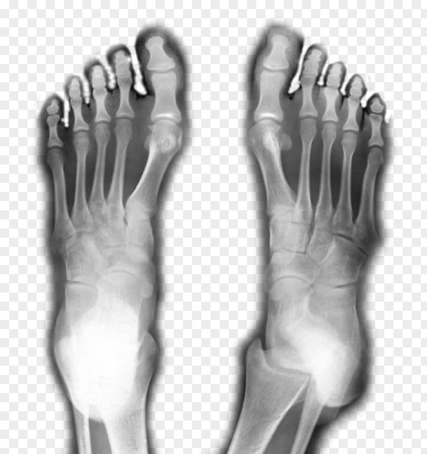 Thumb Podiatry Foot Surgery Ankle PNG