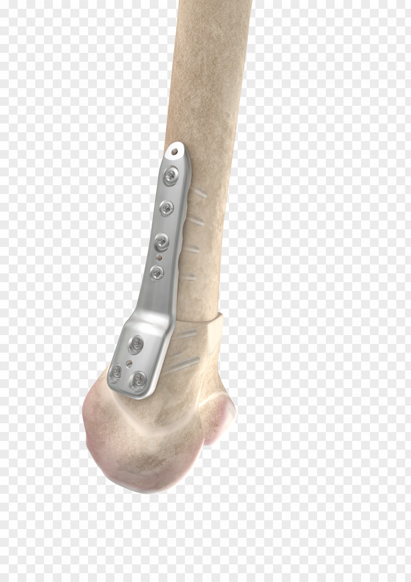 Femur Osteotomy Distal Joint Knee Tibia PNG