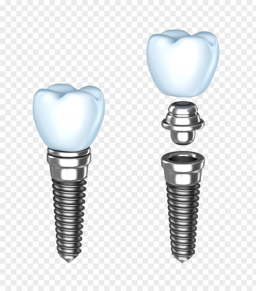 Implants Dental Implant Dentistry Dentures Human Tooth PNG