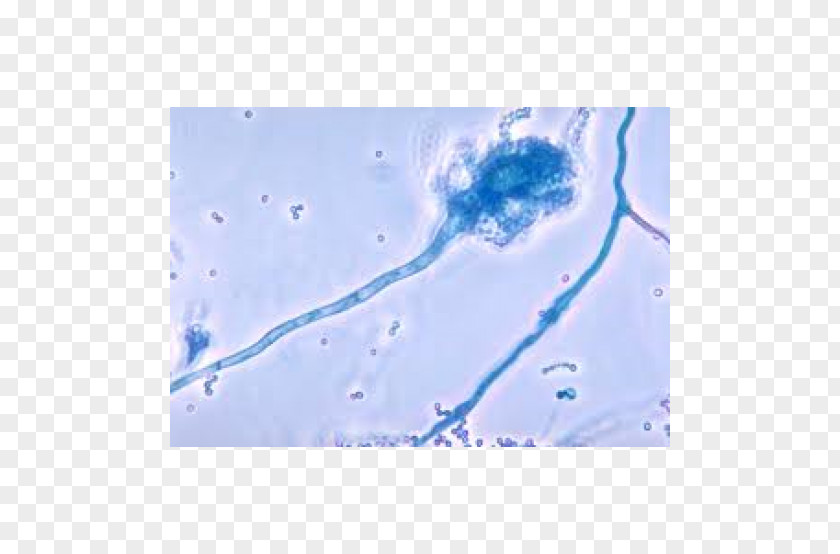 Aspergillus Fumigatus Fungus Aspergillosis Aspergilloma Infection PNG