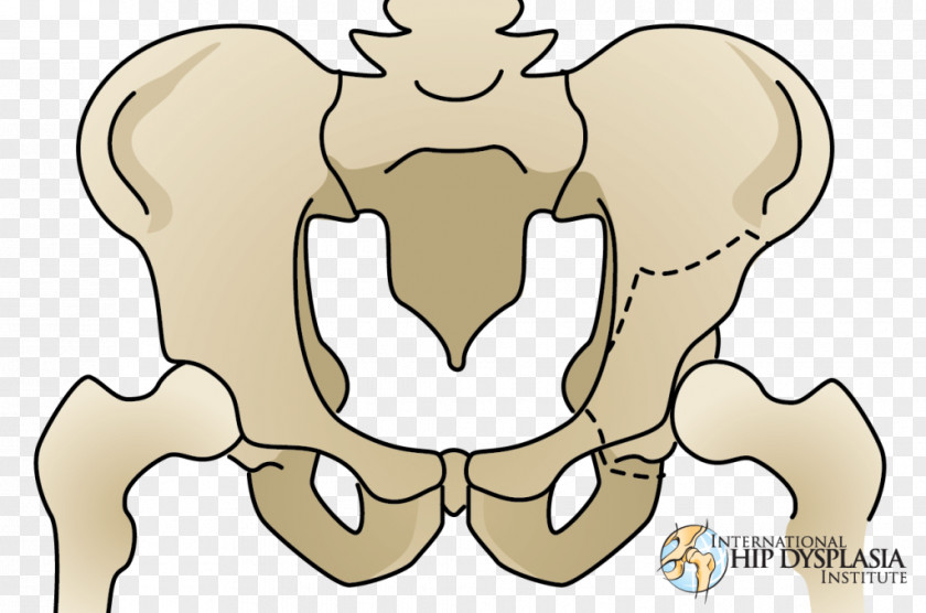 Osteotomy Hip Dysplasia Acetabulum Pelvis PNG