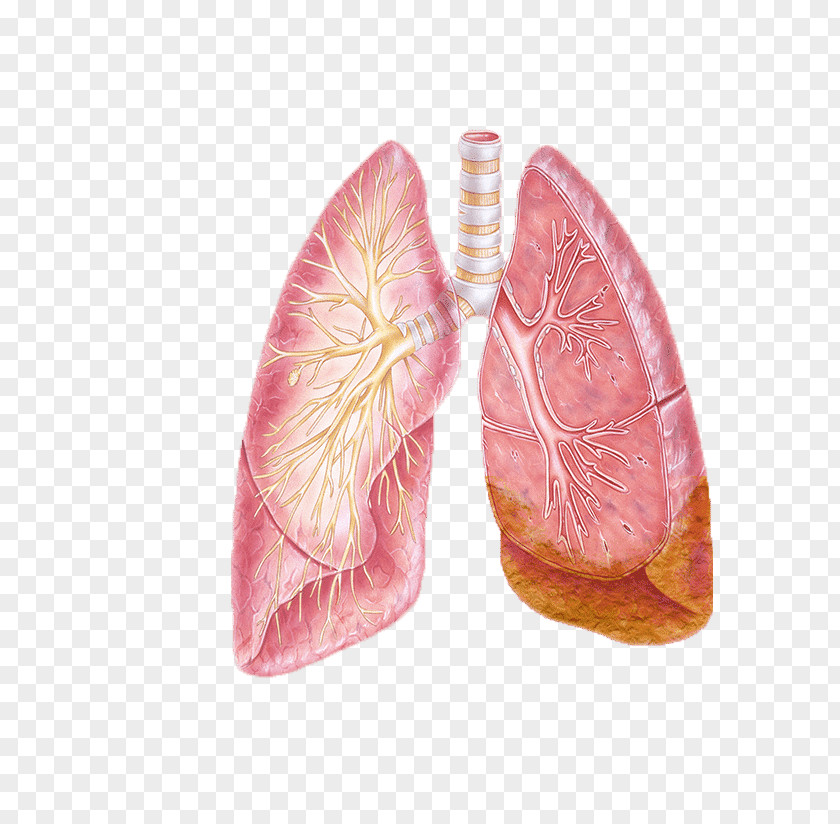 Non-small Cell Lung Cancer Bronchus PNG