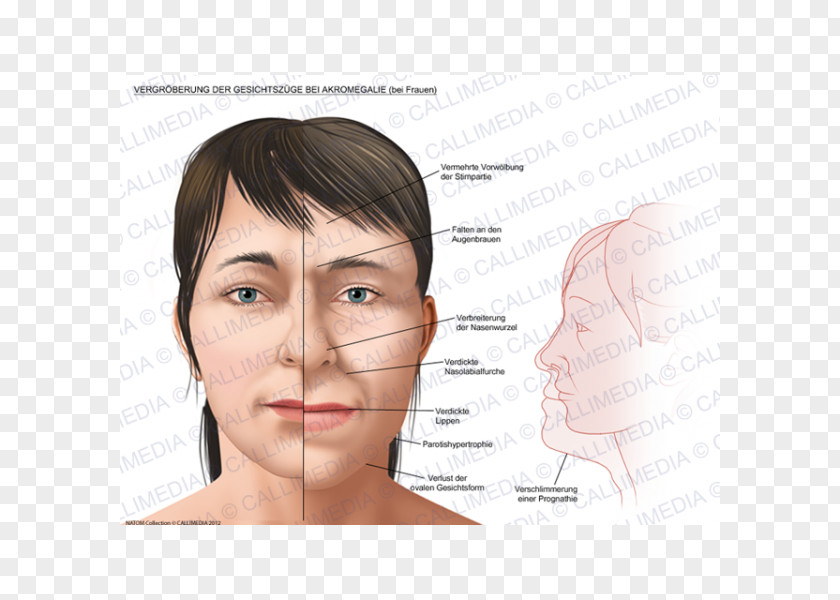 Face Acromegaly Gigantism Growth Hormone Image PNG