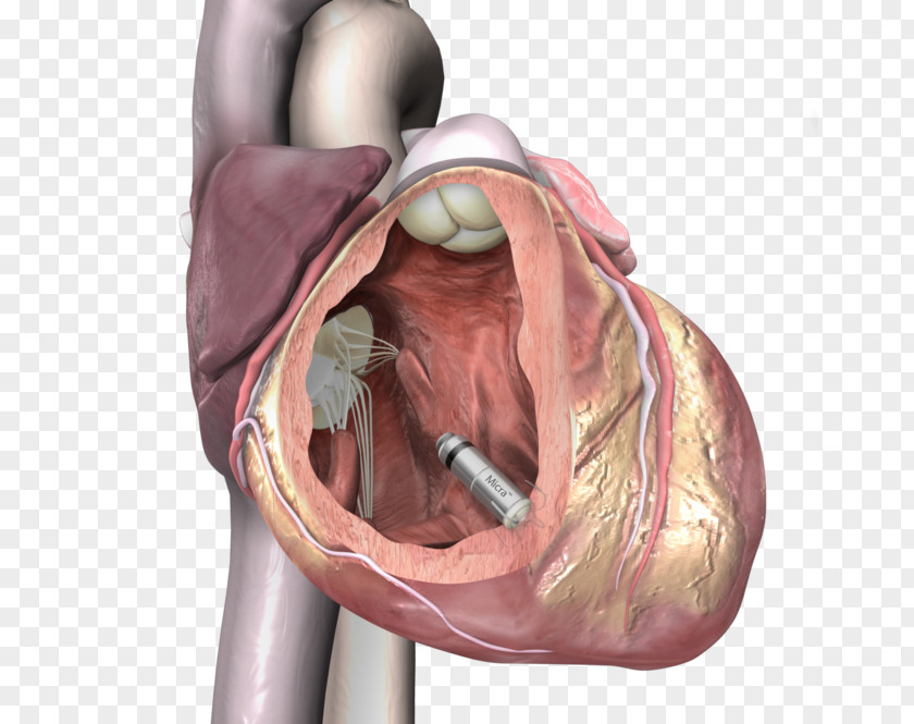 Heart Artificial Cardiac Pacemaker Medtronic Implantable Cardioverter-defibrillator Cardiology PNG