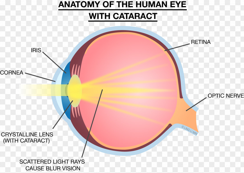 Light Eye Lens Strength Training Anatomy Cataract PNG
