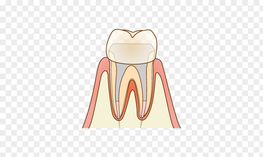 Endodontic Therapy 歯科 Dentist Root Canal Tooth Decay PNG