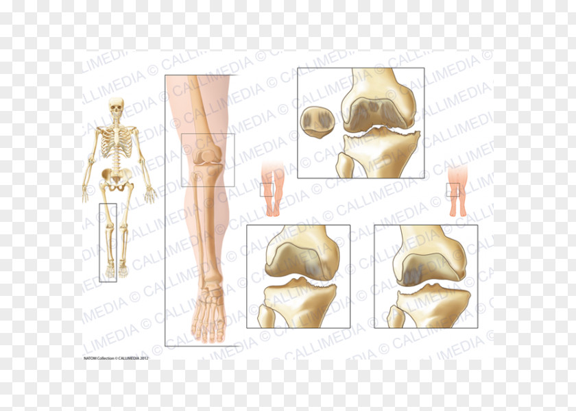 Artrosis De Rodilla La Gonarthrose Knee Osteoarthritis Arthritis PNG