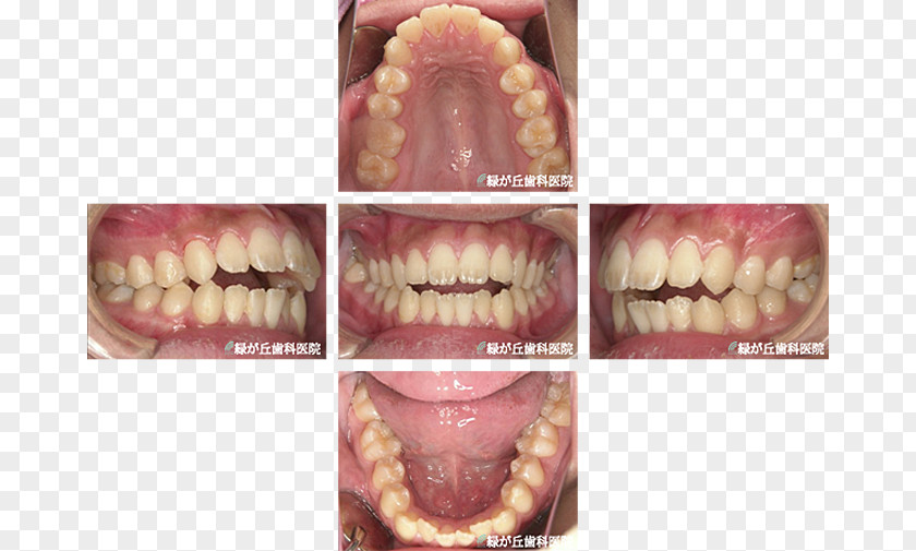 Ortho 矯正歯科 Dentist Dental Braces Dentition Tooth PNG