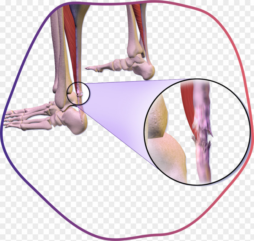 Torn Hamstring Symptoms Achilles Tendon Rupture Tendinitis PNG