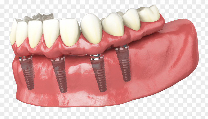 Bridge Tooth Dental Implant Dentures Dentistry PNG
