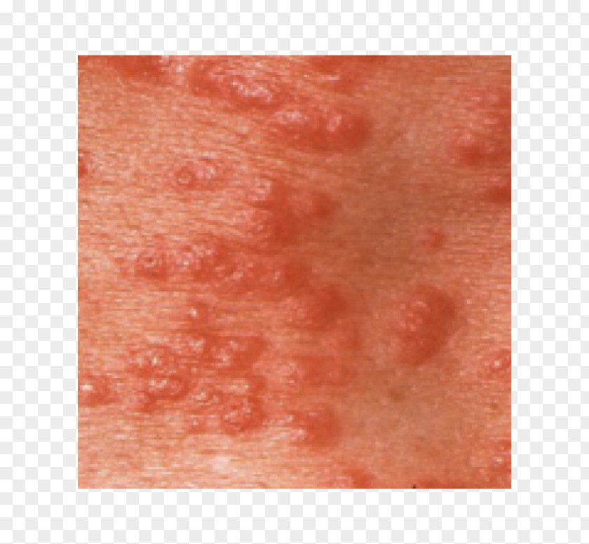Red Orb Cancer Virus Cell Scabies Skin Rash Close-up PNG