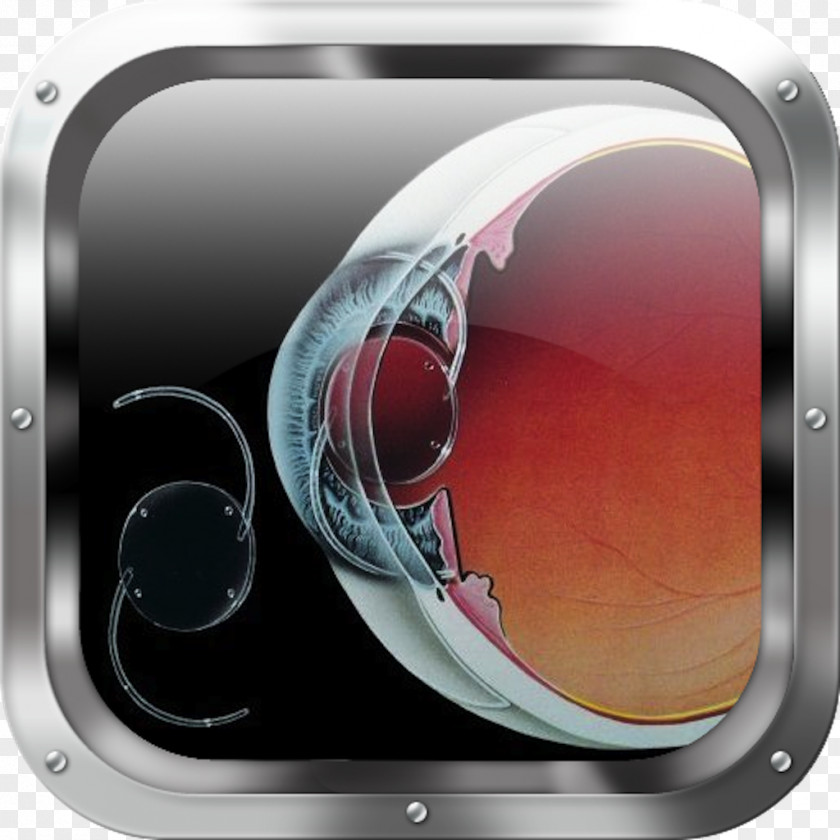 Eye Intraocular Lens Retinal Detachment Cataract Surgery PNG