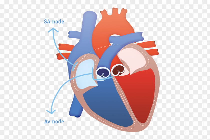 Heart Subcutaneous Implantable Defibrillator Cardiac Arrest Sudden Death Cardioverter-defibrillator PNG