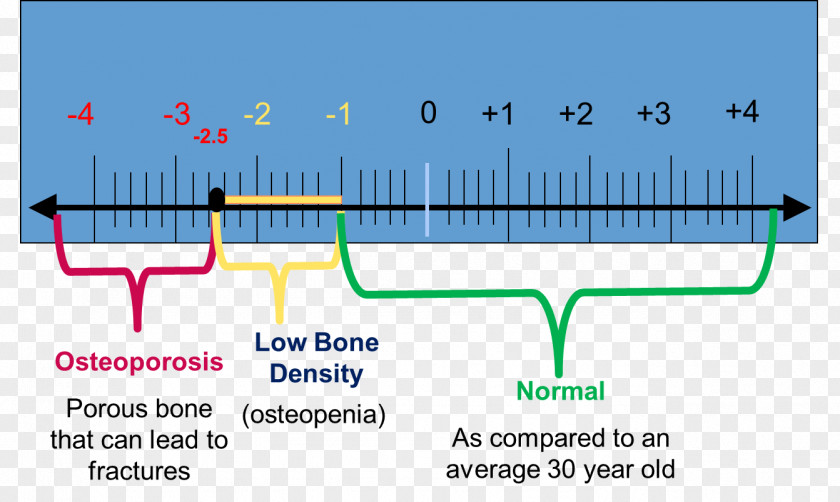 Test Score Bone Density Dual-energy X-ray Absorptiometry Osteopenia Densitometry PNG