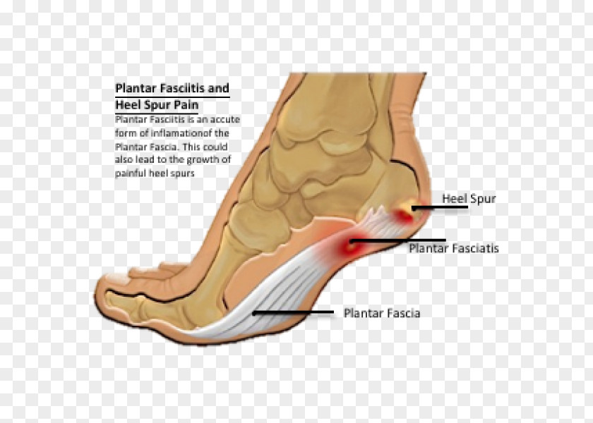 Heel Pain Calcaneal Spur Plantar Fasciitis Foot PNG